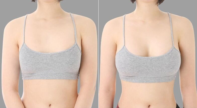 před a po augmentaci prsou