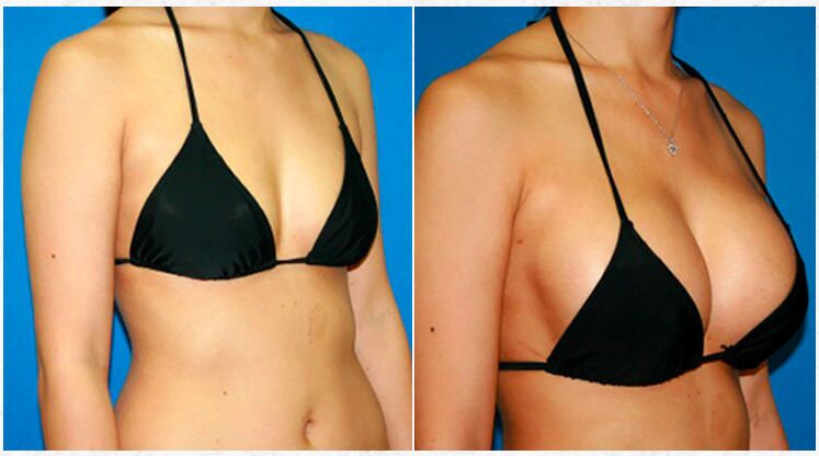 Před a po augmentaci prsou plastickou operací