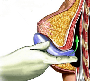 implantace pro zvětšení prsou