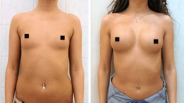 fotografie před a po chirurgickém zvětšení prsou