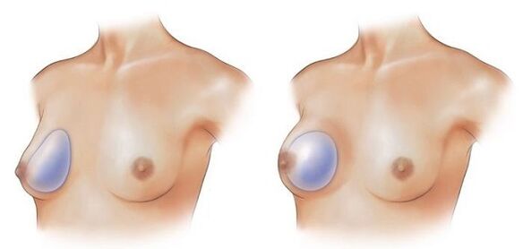kapkovité a kulaté implantáty pro zvětšení prsou