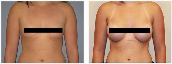 prsa před a po operaci