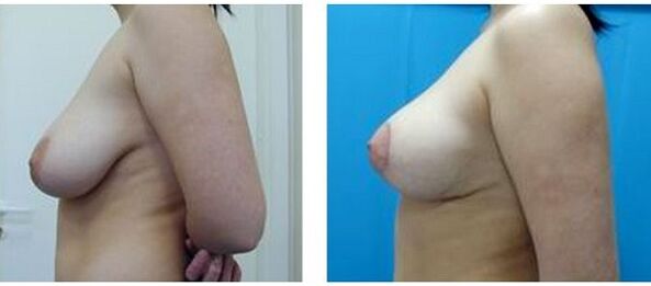 před a po chirurgickém zvětšení prsou