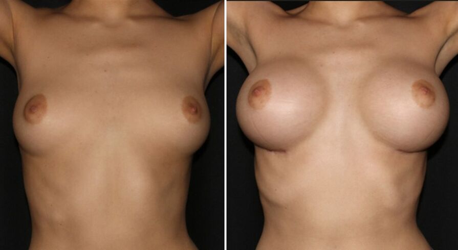 Před a po operaci zvětšení prsou